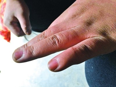 哥為給弟看病無(wú)錢支付彩禮 夫妻吵架自殘剁手指 哥為給弟看病無(wú)錢支付彩禮 夫妻吵架自殘剁手指