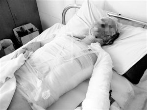 周小姐的頭、頸、軀干、四肢均被燒傷，其中面部燒傷最為嚴(yán)重。