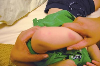 孩子身上有多處明顯傷痕。京華時報讀者供圖