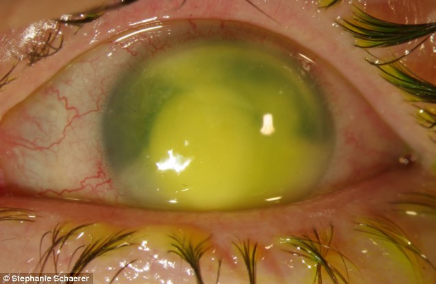 恐怖慎入！隱形眼鏡致英女子摘除眼球