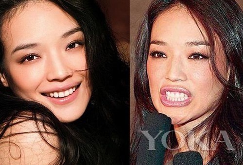 牙齒凸出，口輪肌過于松弛