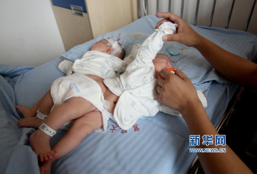 一對(duì)連體女?huà)氤晒Ψ蛛x