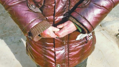 長期受損的手指，已經(jīng)長在了一起。