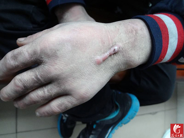被發(fā)現(xiàn)男子手上的傷疤。