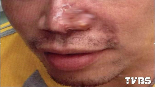 男生為追學(xué)妹整成“李敏鎬鼻”術(shù)后鼻翼潰爛(圖) 男生為追學(xué)妹整成“李敏鎬鼻”術(shù)后鼻翼潰爛(圖)