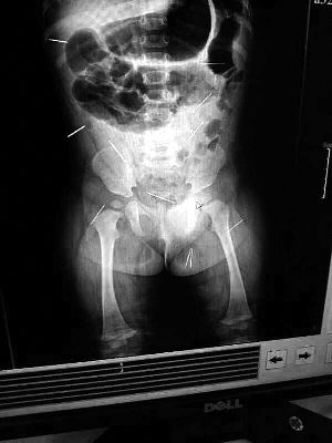 目前體內(nèi)的12根鋼針多分布在孩子的臀部，一根在腹部，其余3根在胸腔附近，其中一根很接近心臟