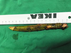 插入男子腦內(nèi)的樹(shù)枝。