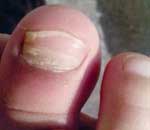 一幼兒園兒童“指甲異?！? title=